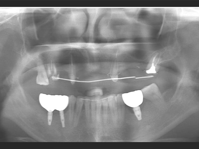 All-on-6 顴骨植體上顎重建（X-ray）