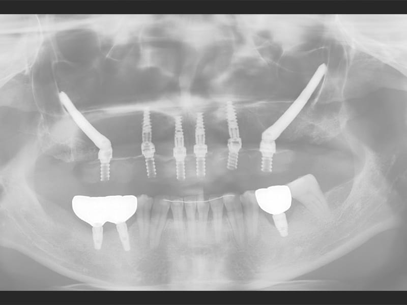 All-on-6 顴骨植體上顎重建（X-ray）