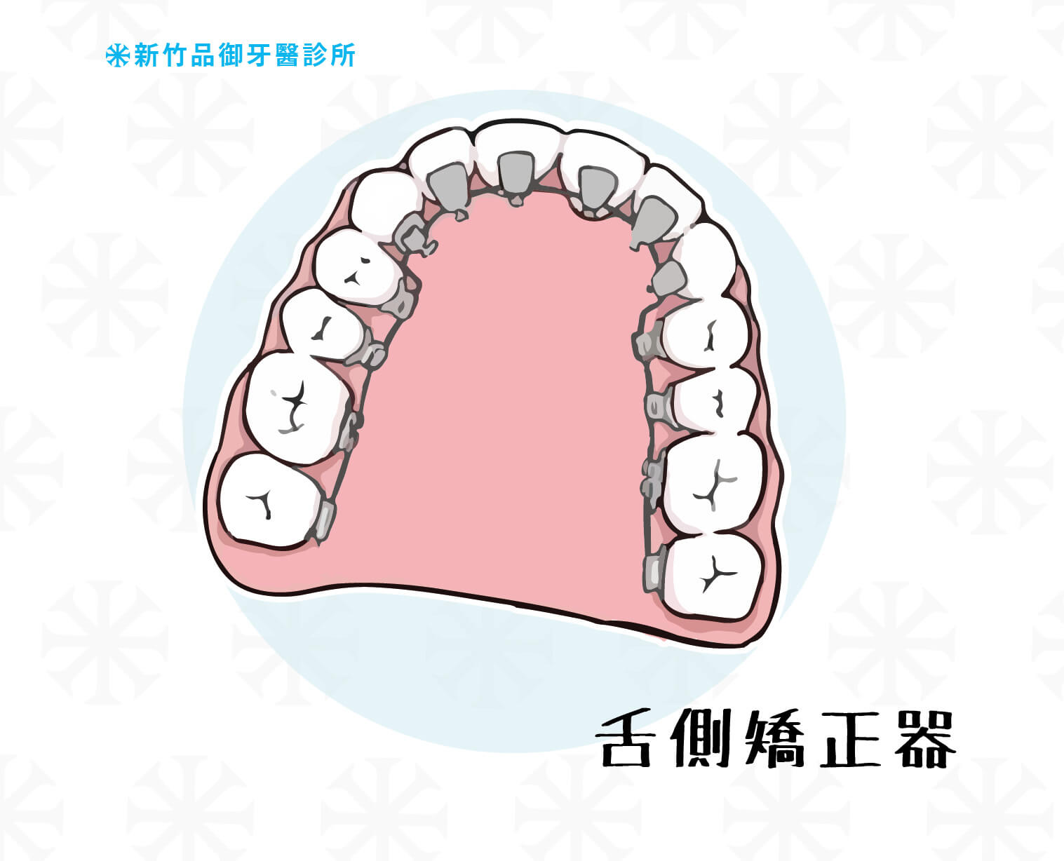 舌側矯正器