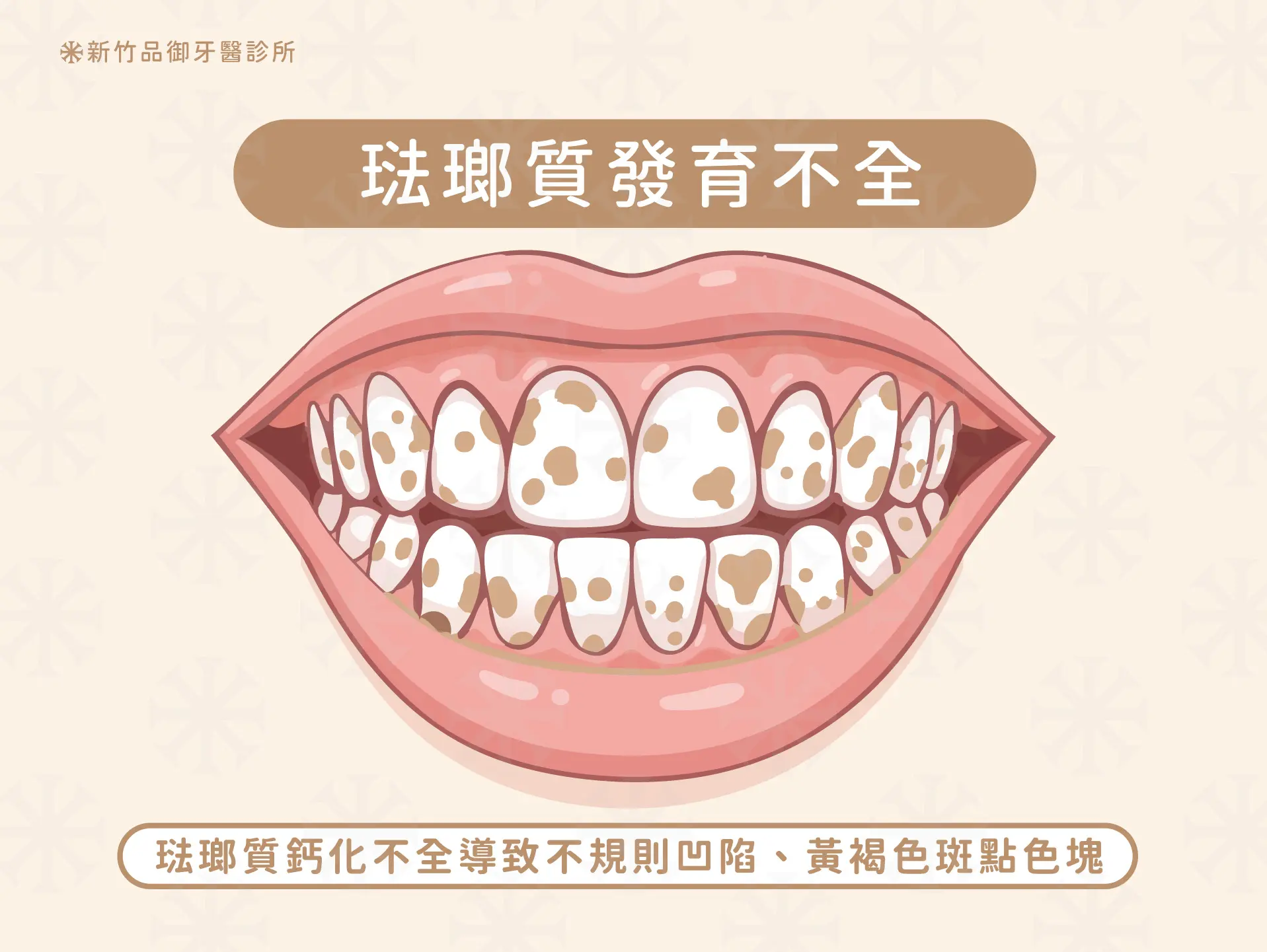琺瑯質鈣化不全導致的不規則凹陷、黃褐色斑點色塊,也必須倚靠全瓷冠/陶瓷貼片才能改善。