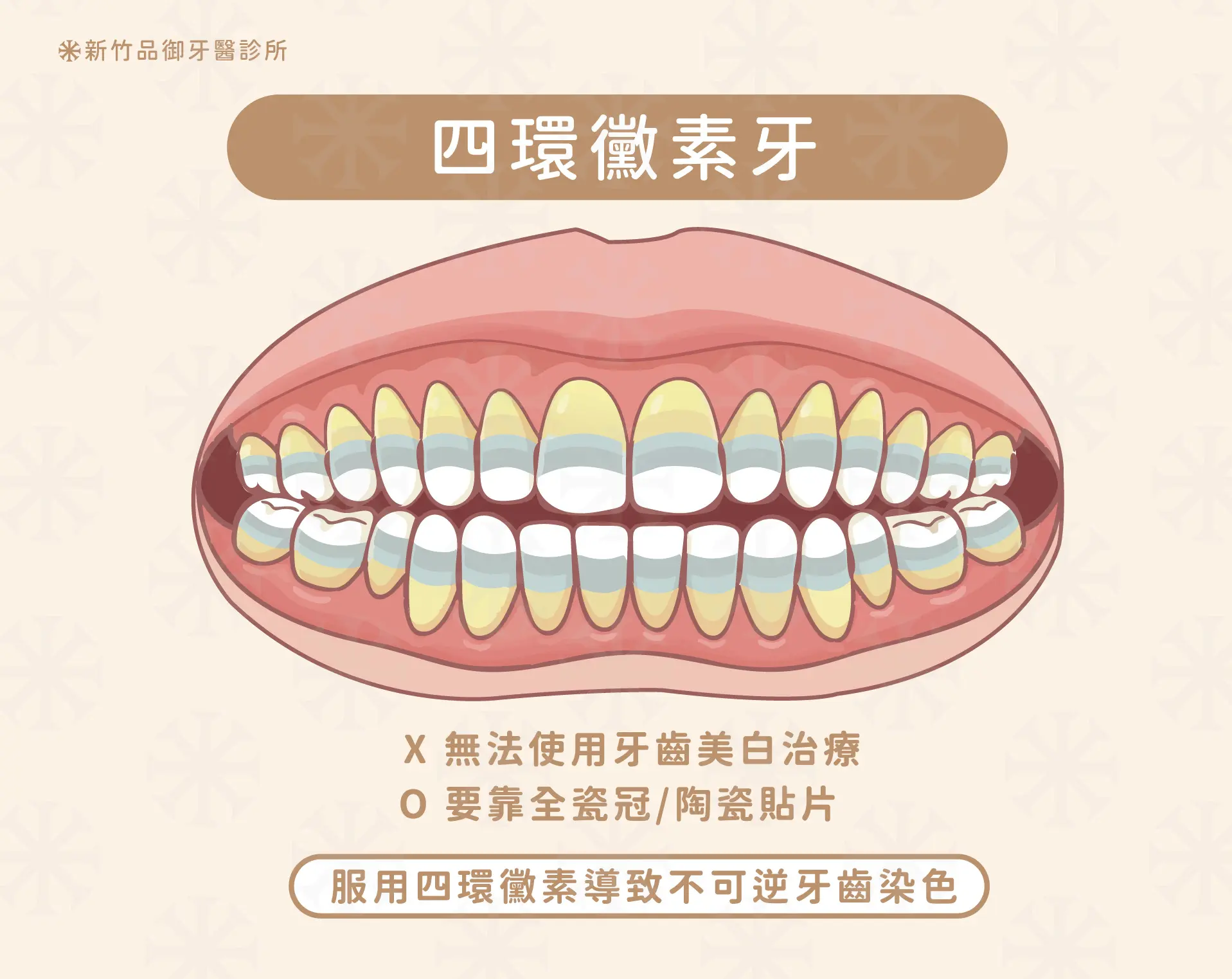 因服用四環黴素導致牙齒染色的「四環黴素牙」,無法使用牙齒美白治療,必須倚靠全瓷冠/陶瓷貼片改善。