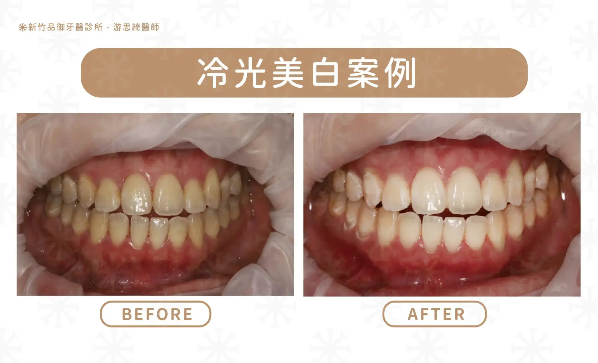 冷光美白案例|游思綺醫師 品御牙醫