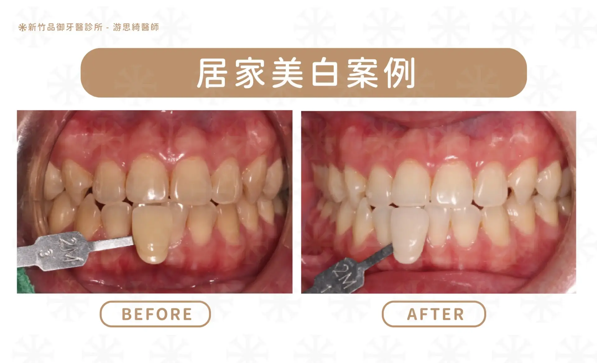 居家美白案例|游思綺醫師 品御牙醫