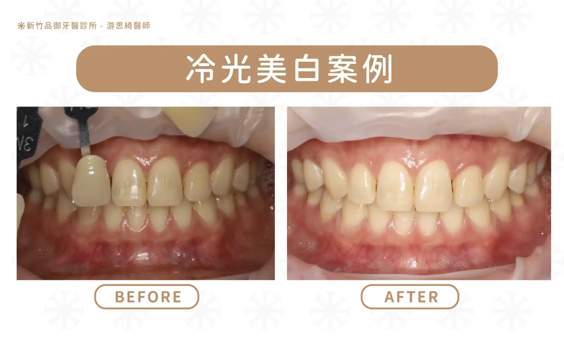 冷光美白案例|游思綺醫師 品御牙醫