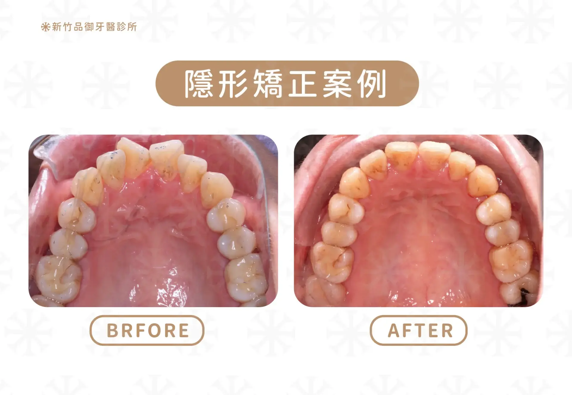 隱形矯正案例|案例提供:李威風醫師 品御牙醫