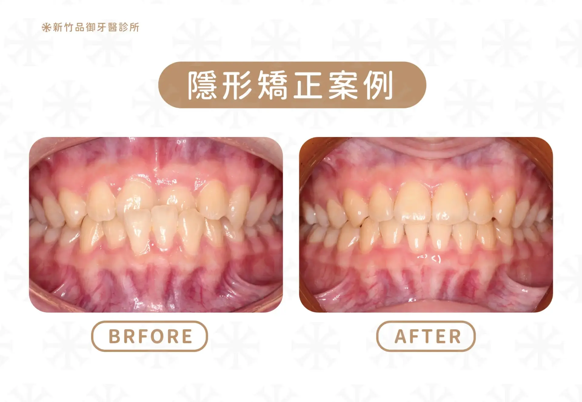 隱形矯正案例|案例提供:李威風醫師 品御牙醫