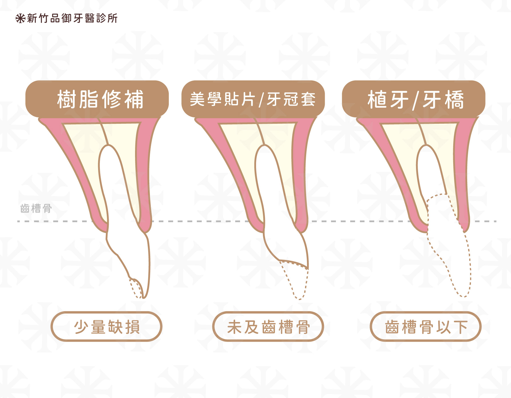 根據門牙缺損的範圍不同,需要的治療手段也不一樣。