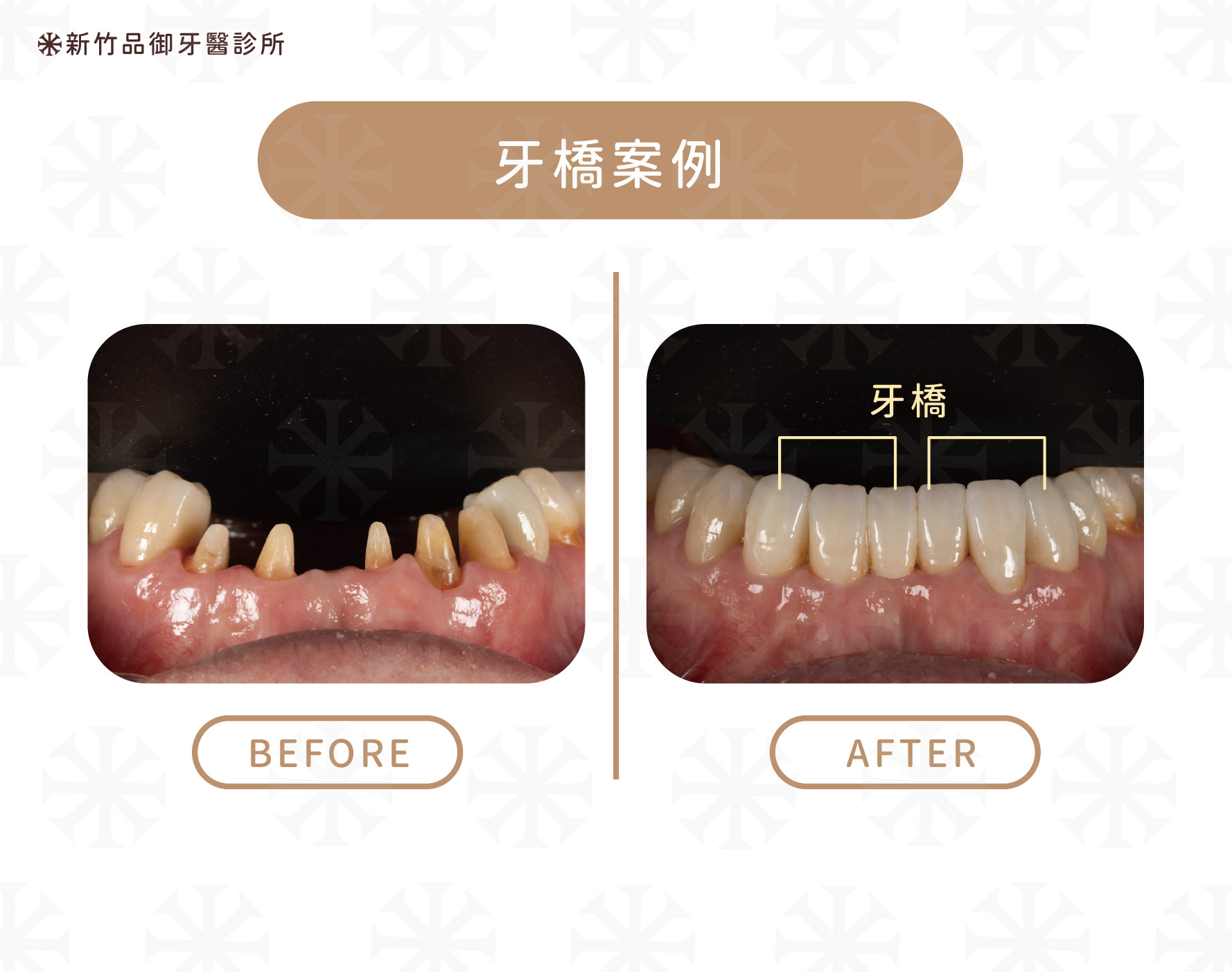 案例提供:楊博任醫師 品御牙醫
牙橋案例