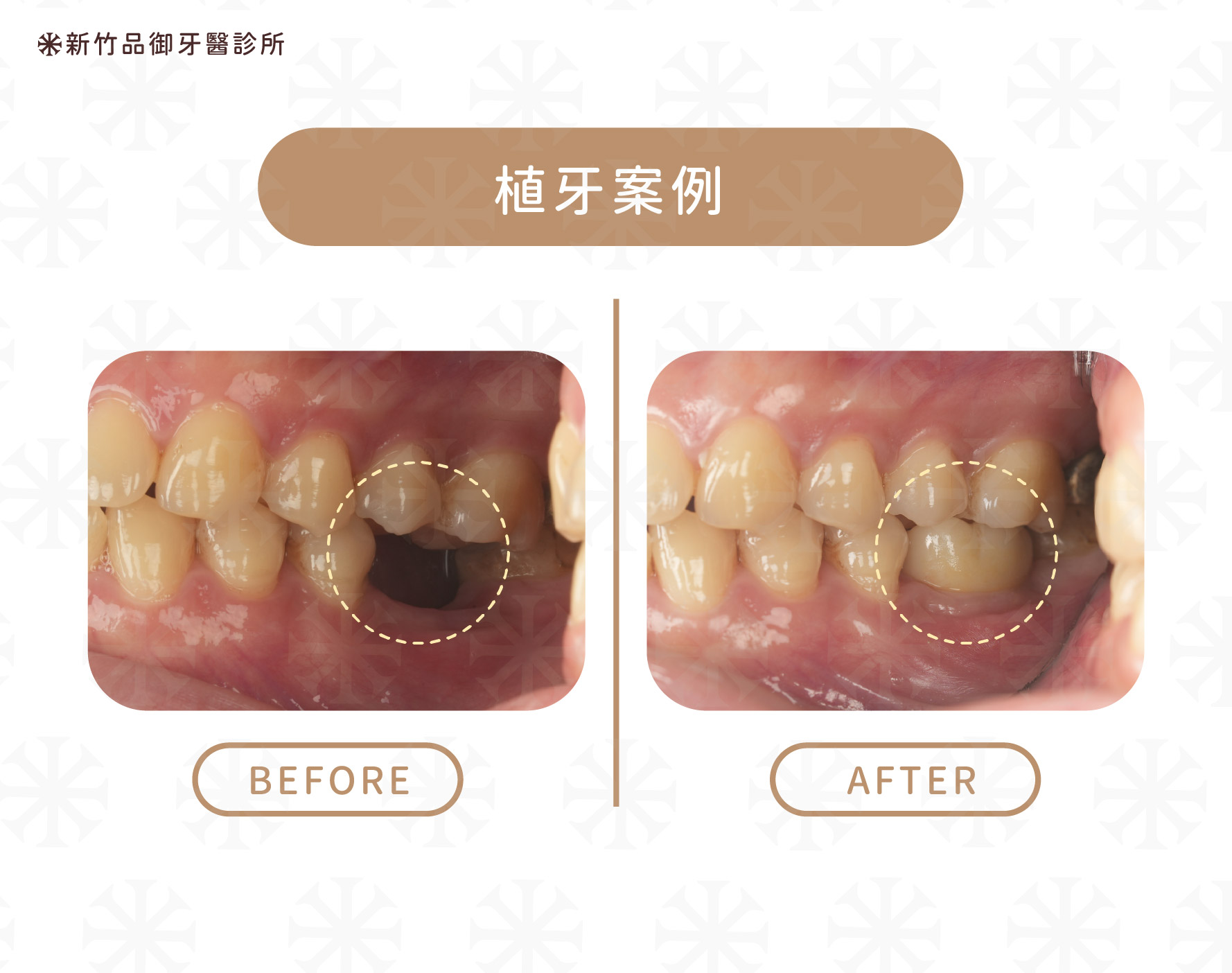 手術醫師:李俊瑩醫師 假牙醫師:楊博任醫師
品御牙醫
植牙案例