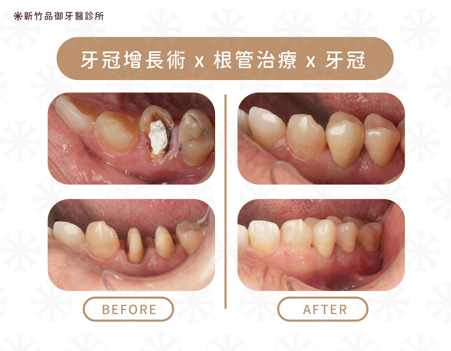 案例提供:楊博任醫師 品御牙醫
牙冠增長樹X根管治療X牙冠案例