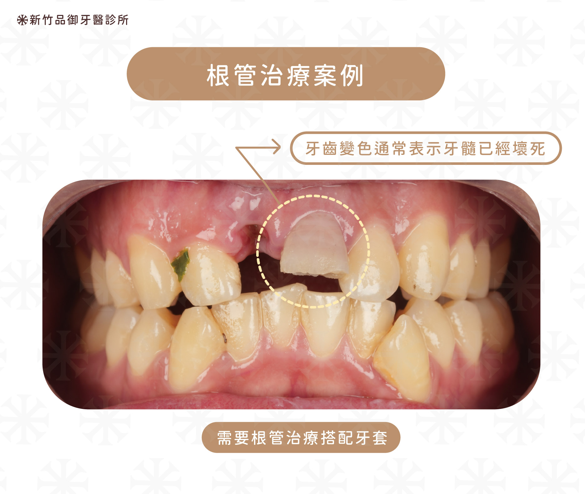 案例提供:楊博任醫師 品御牙醫
如果門牙撞斷後牙齒已經變色了(如上圖),通常代表的是:牙髓已經壞死了。這時醫師會進行「牙齒活性測試」,若牙齒判定壞死後,需要進行根管治療,把壞死的神經清除乾淨。