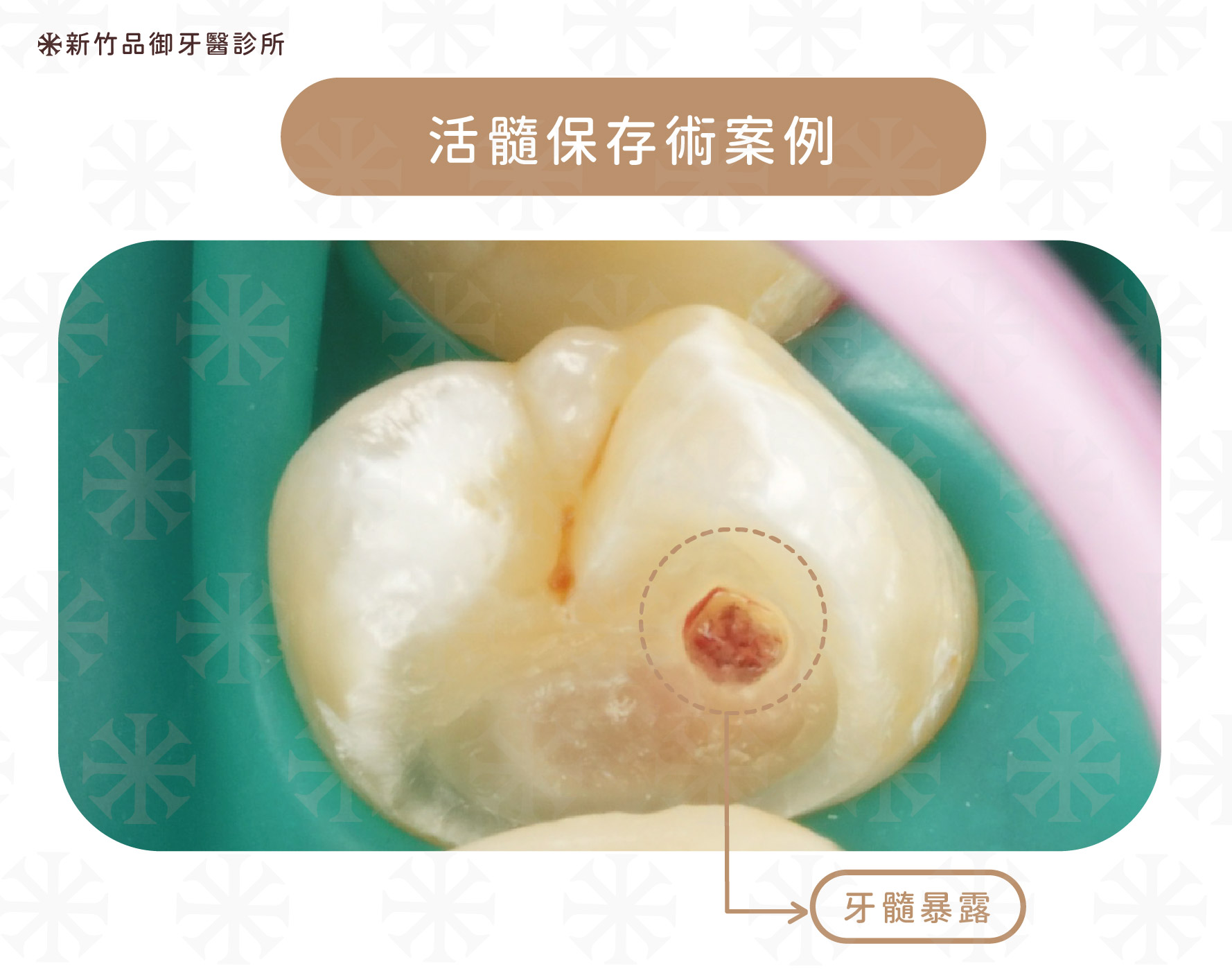 活髓保存案例,圖為牙髓暴露
案例提供:楊博任醫師 品御牙醫