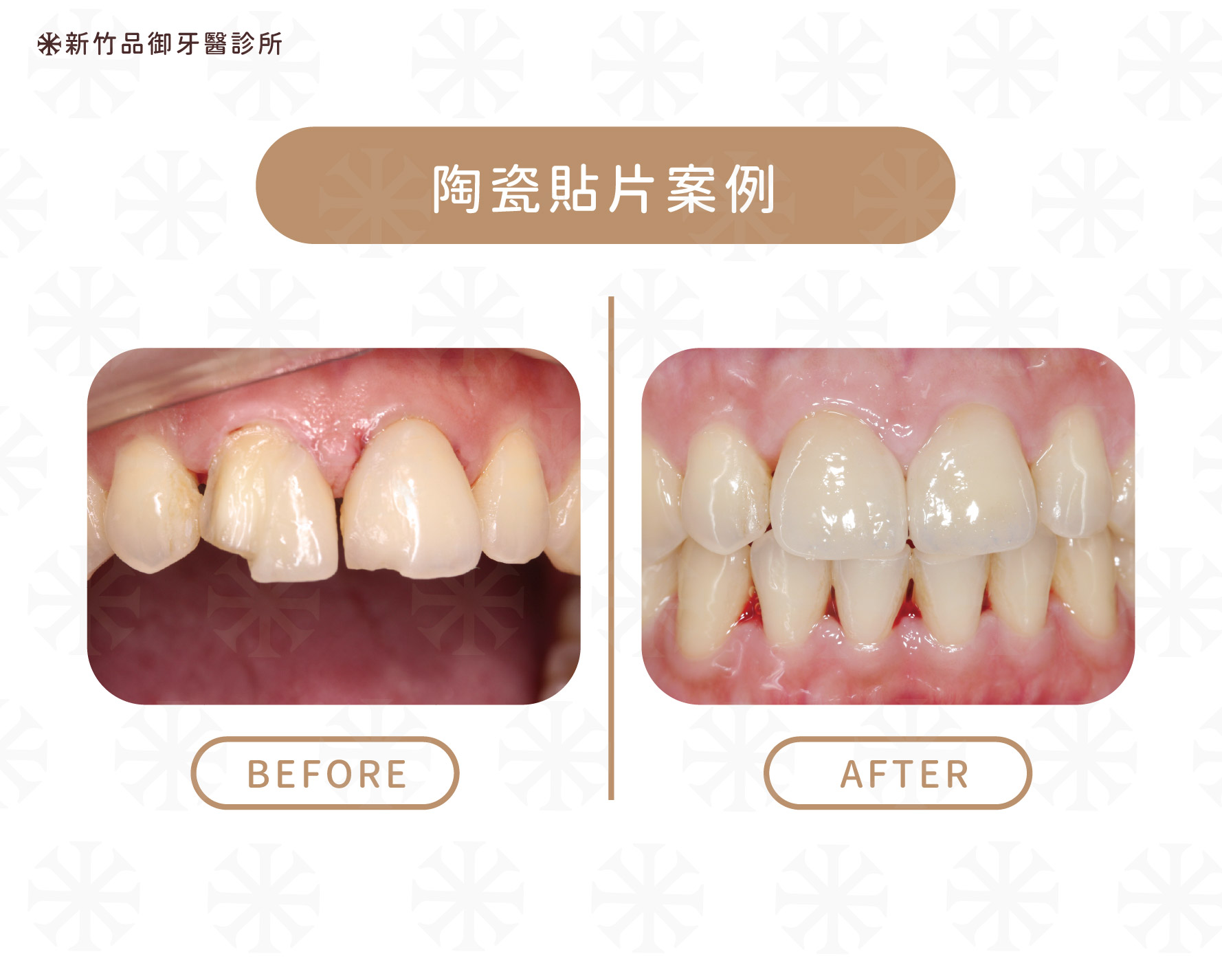 陶瓷貼片案例
案例提供:蔡濰仲醫師 品御牙醫
