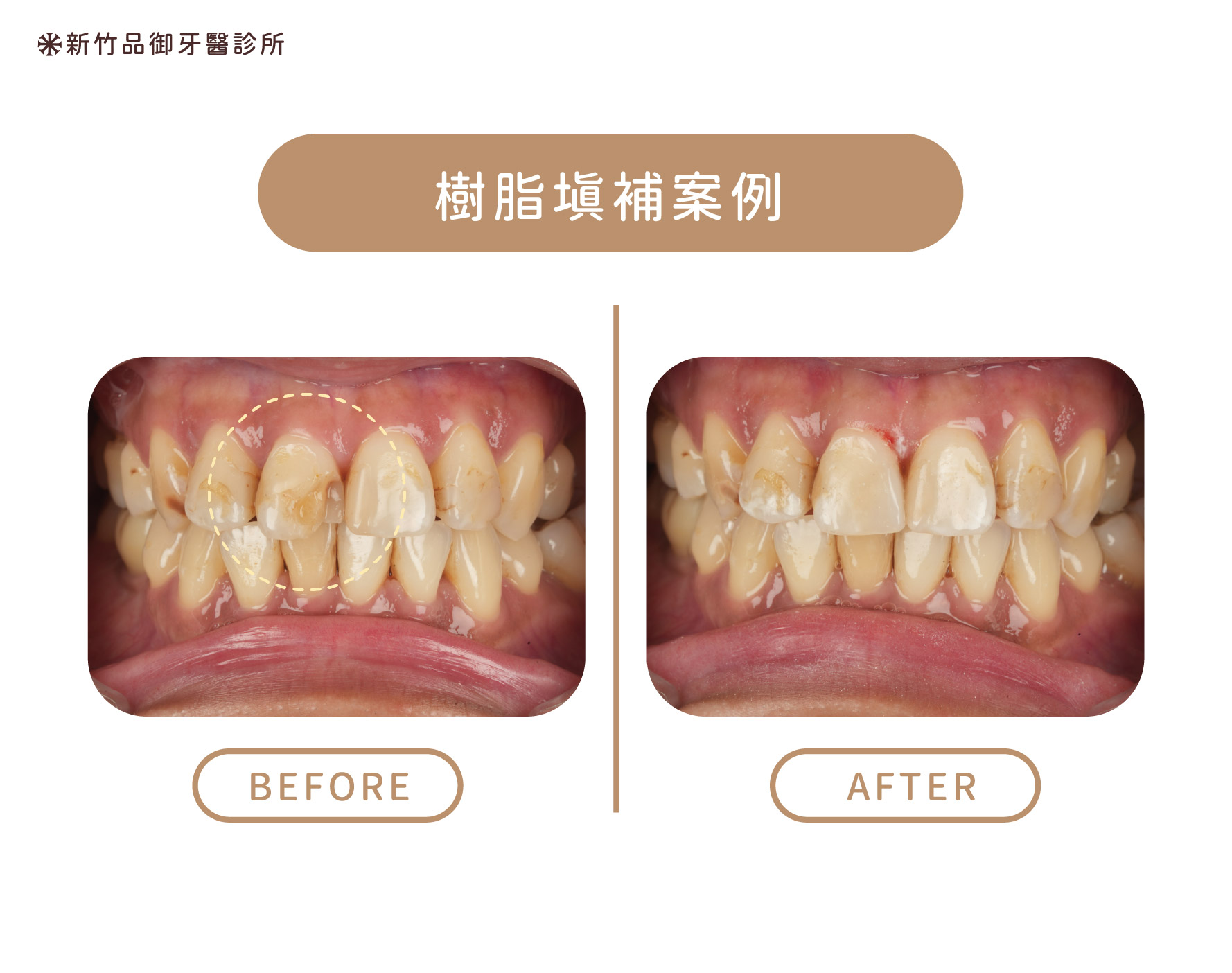 樹脂填補案例
案例提供:楊博任醫師 品御牙醫