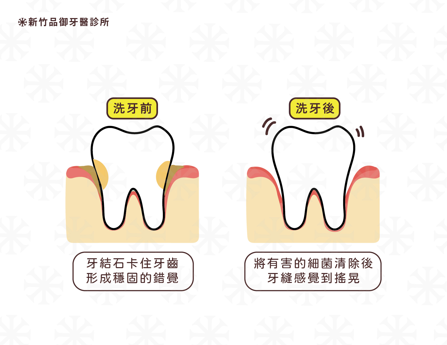 不同牙齒表面的牙結石慢慢的疊加在一起,而讓病患感覺牙齒很穩固,實際上很有可能牙齒周圍的骨頭已經破壞很嚴重了,以至於醫師將一整排牙結石清除後,讓病患有洗牙之後反而牙齒變搖晃的感覺,但實際上醫師是將有害身體健康的細菌清除,讓病患更容易維護牙齒清潔。