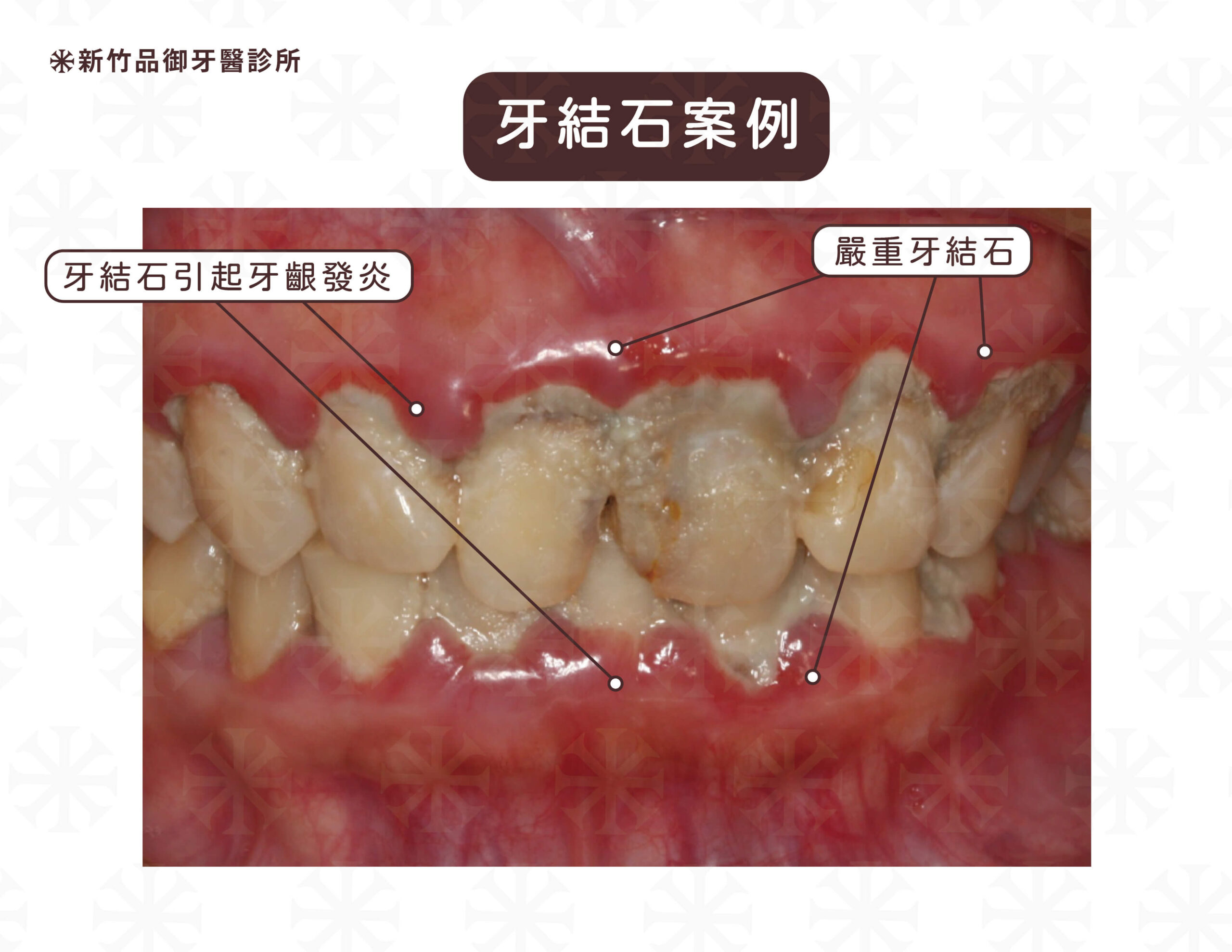 牙結石引起牙齦發炎,洗牙後原本的牙結石附著與牙齒周圍骨頭喪失,會導致感覺冷熱敏感甚至有牙齒搖晃的感覺。