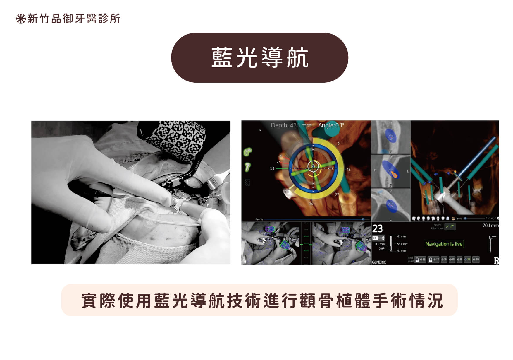 藍光導航技術進行顴骨植體手術情形
案例提供:李俊瑩醫師 品御牙醫