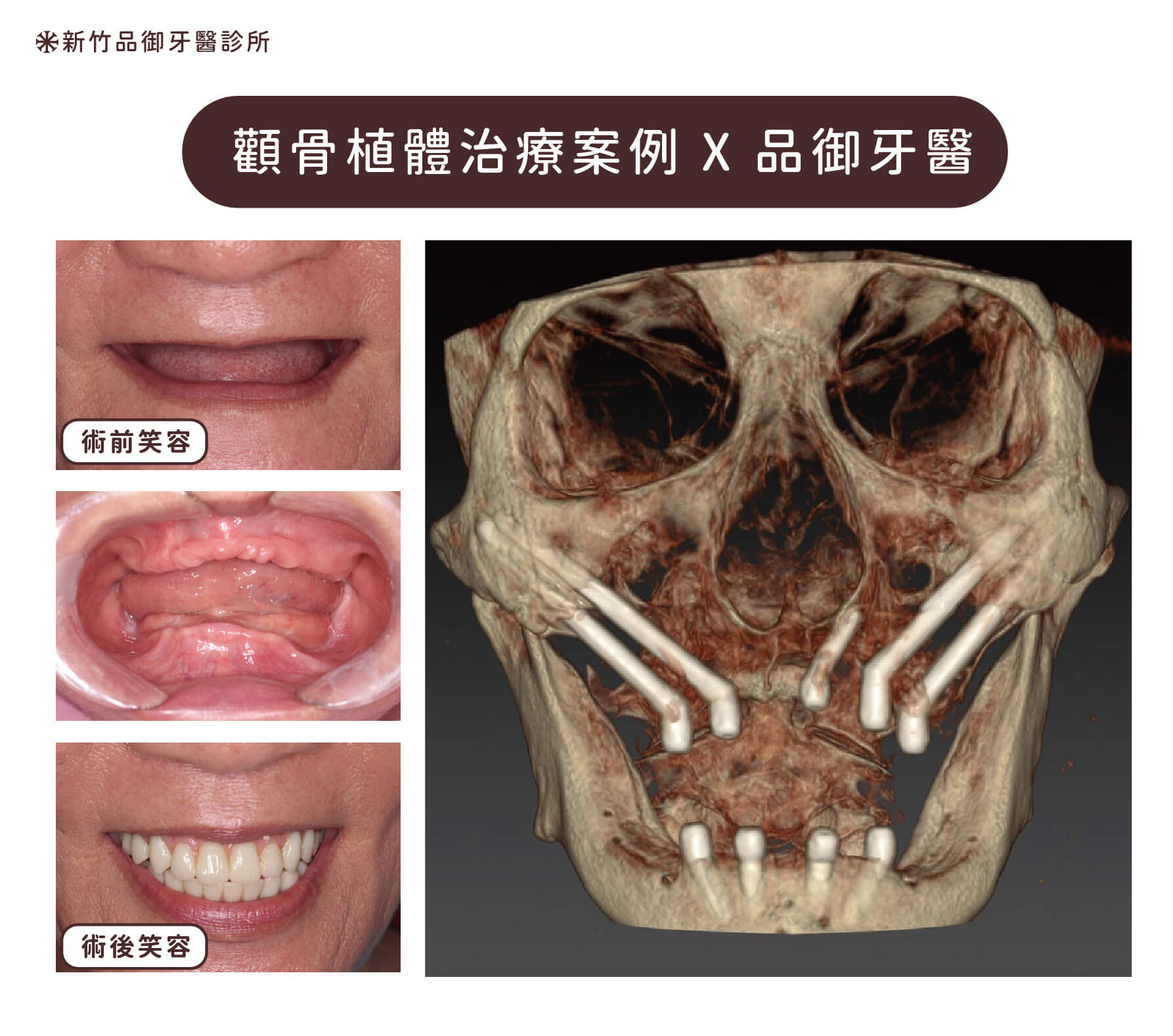 因為上顎骨嚴重萎縮,剩餘齒槽骨無法植牙。因此上顎需要施行四隻顴骨植體支撐固定假牙,這是 All-on-4 治療中最複雜的終極手術