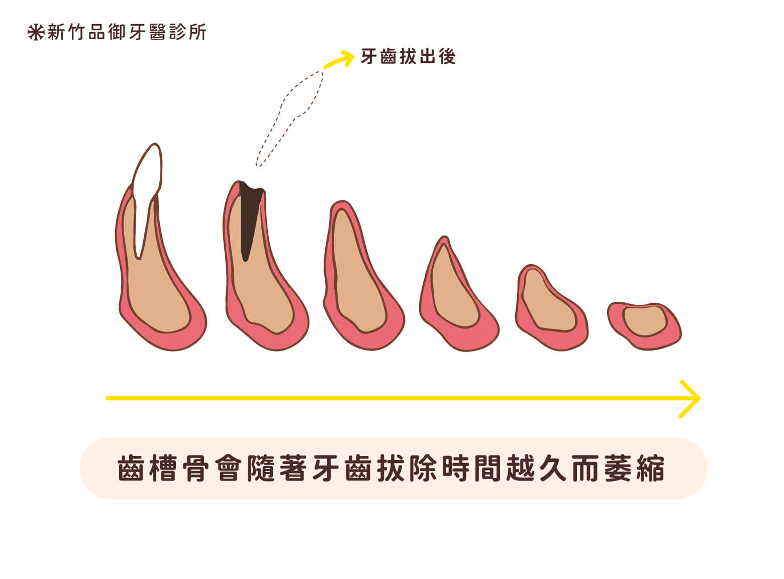 齒槽骨跟牙齦皆會隨著失去牙齒時間越久而萎縮,後續重建困難度會提升。