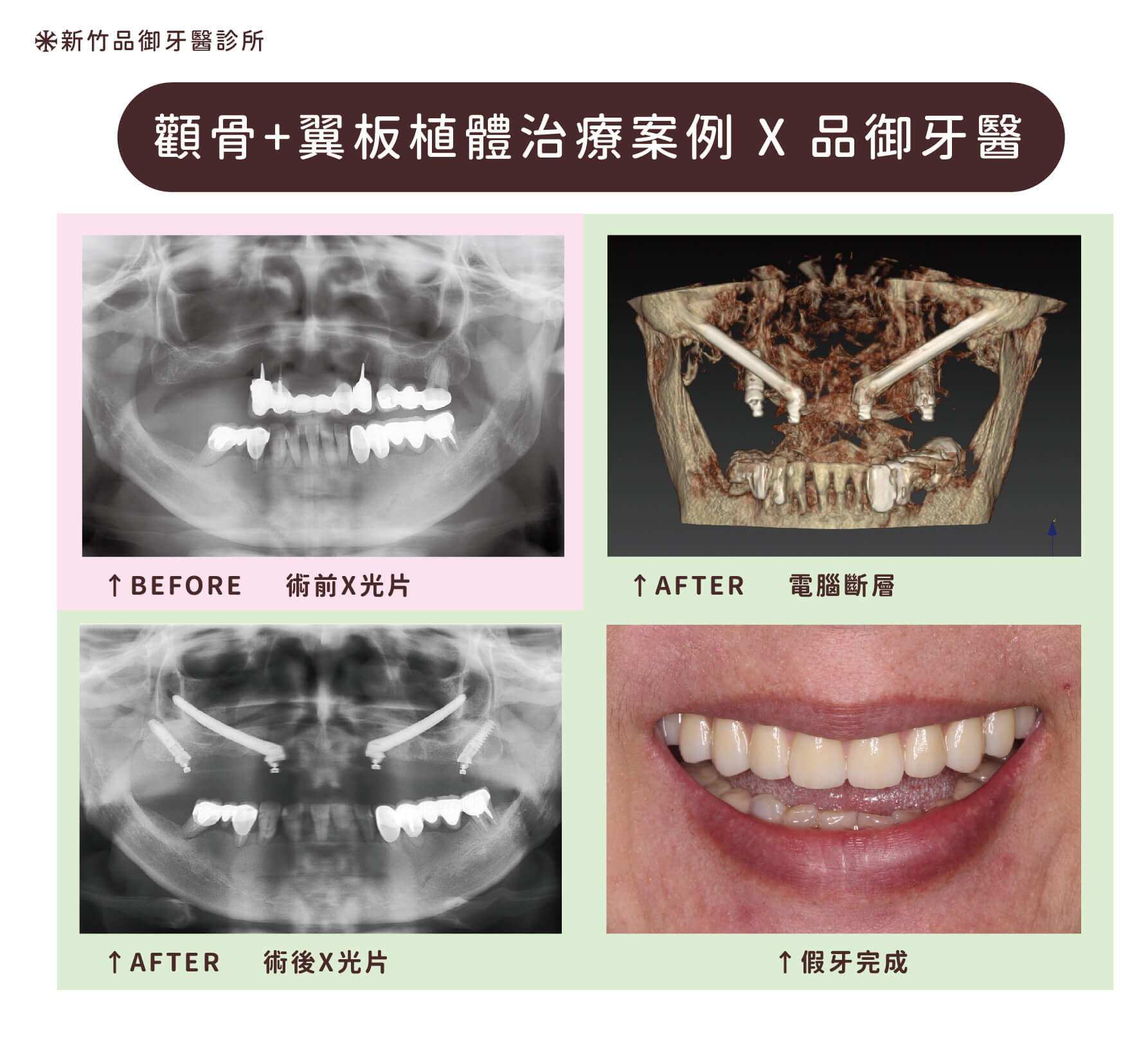 上顎前牙區施行顴骨植體,後牙區施行翼板植體,終於完成固定假牙重建。