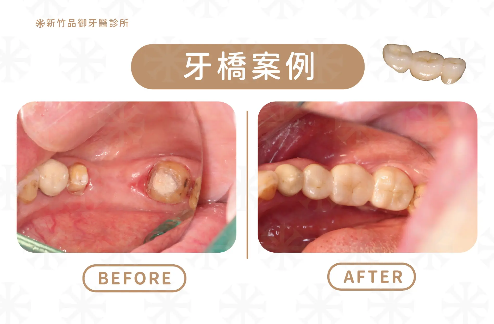 傳統式牙橋案例
案例提供:梁硯林醫師 品御牙醫