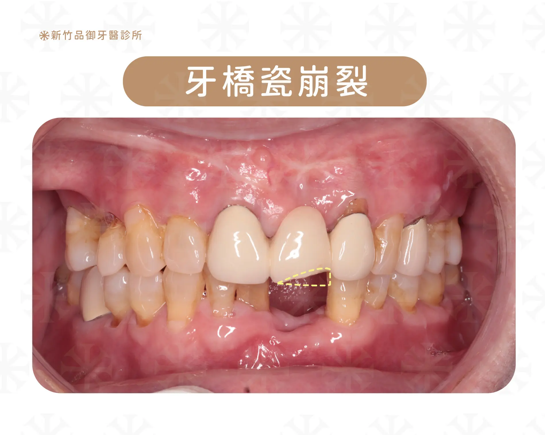 牙橋失敗的原因之一:牙橋損壞
案例提供:梁硯林醫師 品御牙醫