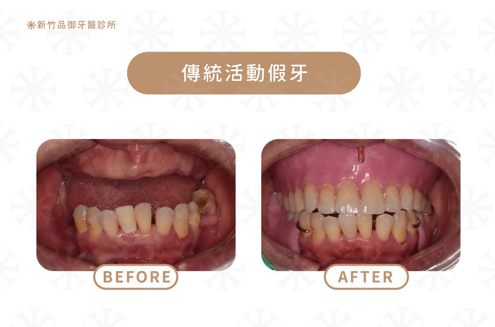 傳統活動假牙|案例提供:梁硯林醫師 品御牙醫