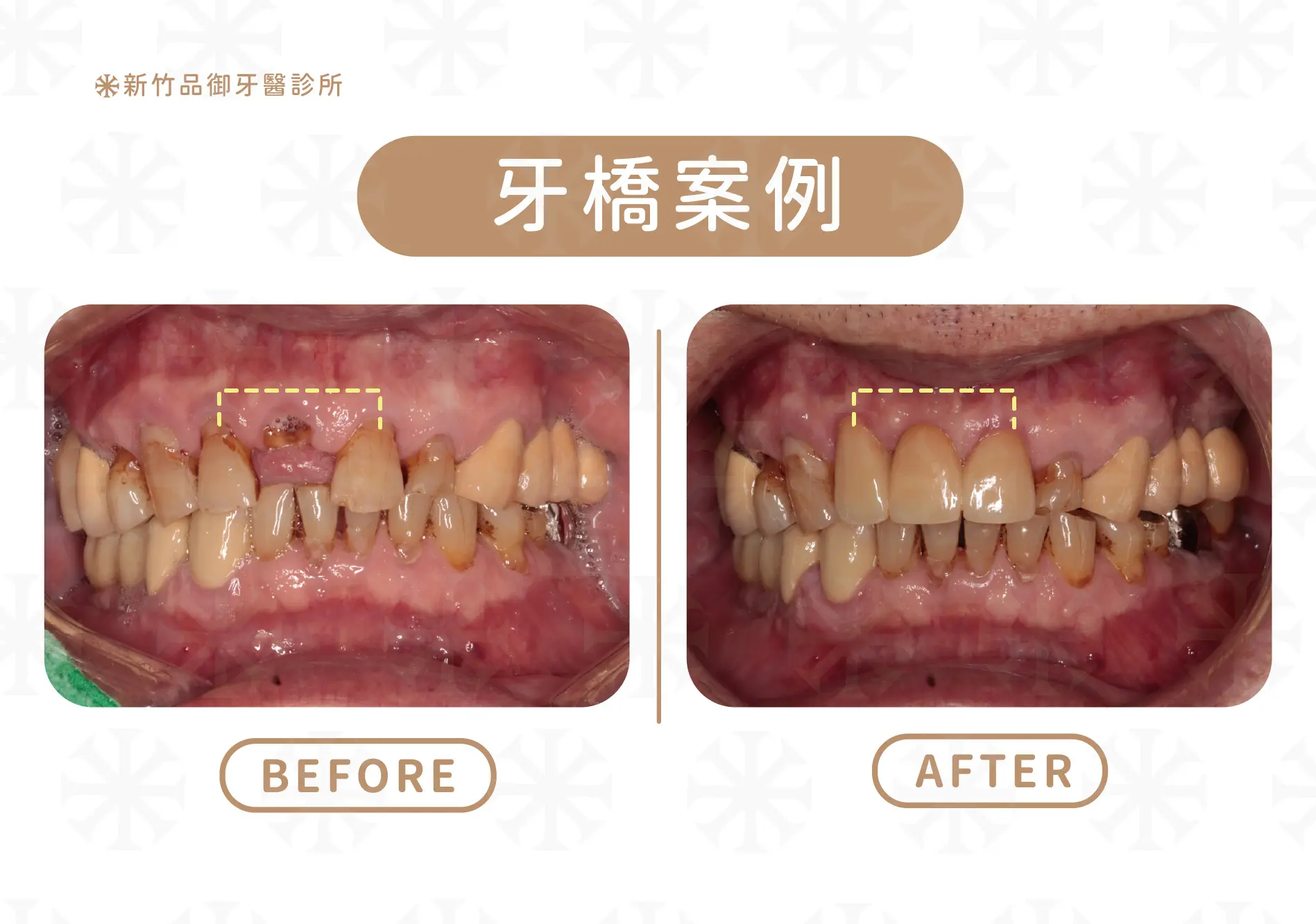 案例提供:梁硯林醫師 品御牙醫