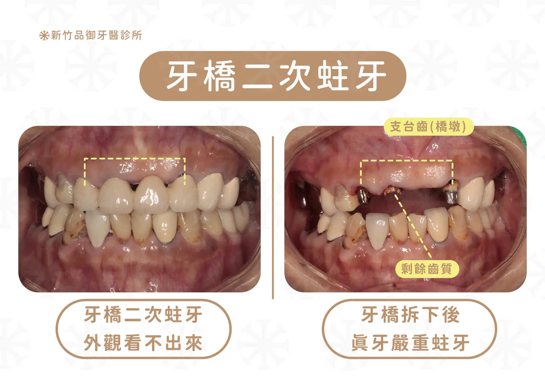 牙橋失敗的原因之一:二次蛀牙
案例提供:梁硯林醫師 品御牙醫