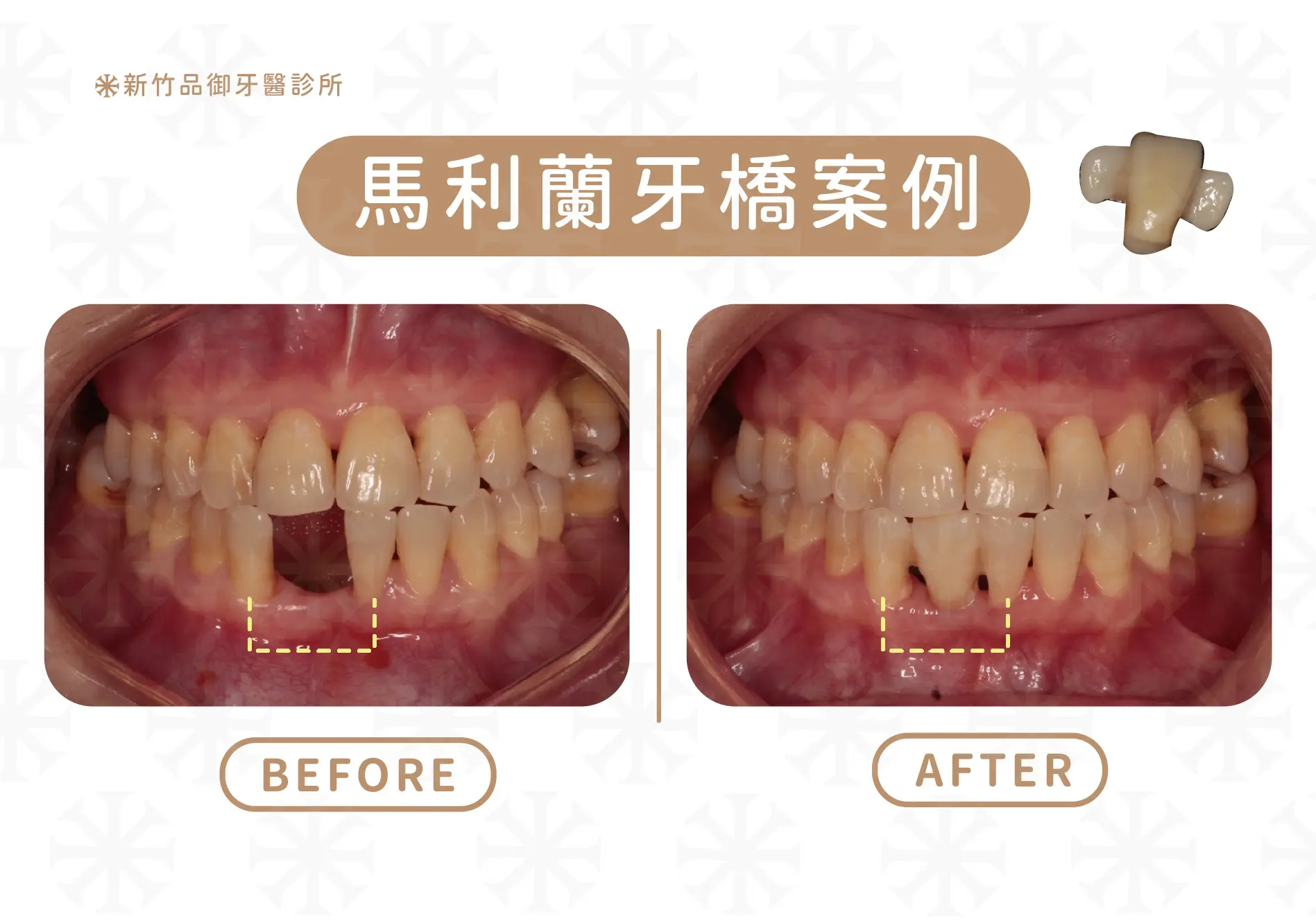 馬利蘭牙橋牙橋案例
案例提供:梁硯林醫師 品御牙醫