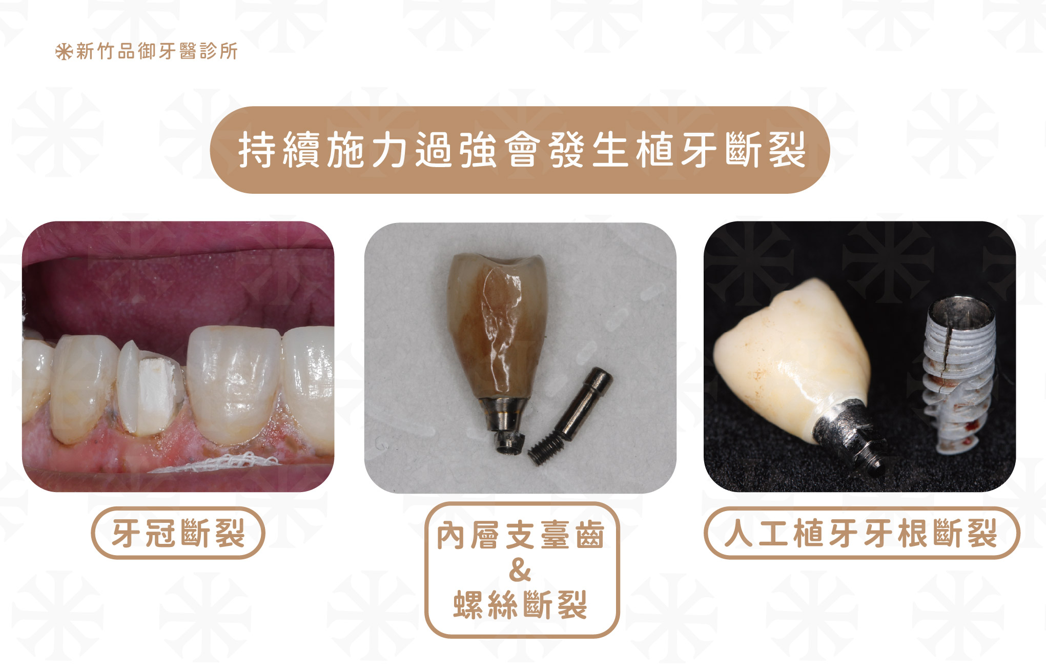 施力過強可能會發生植牙斷裂
案例提供:劉東翰醫師 品御牙醫