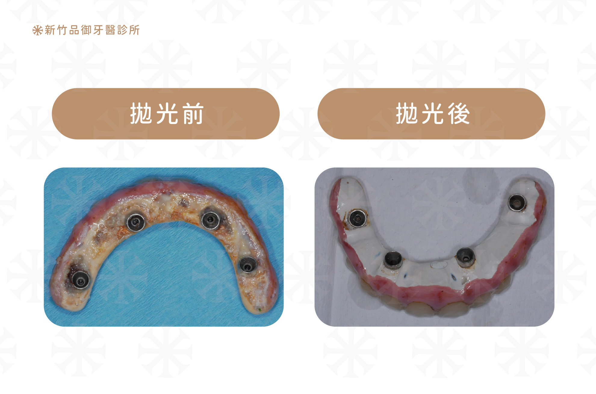 all on 4假牙拋光前後對比|品御牙醫