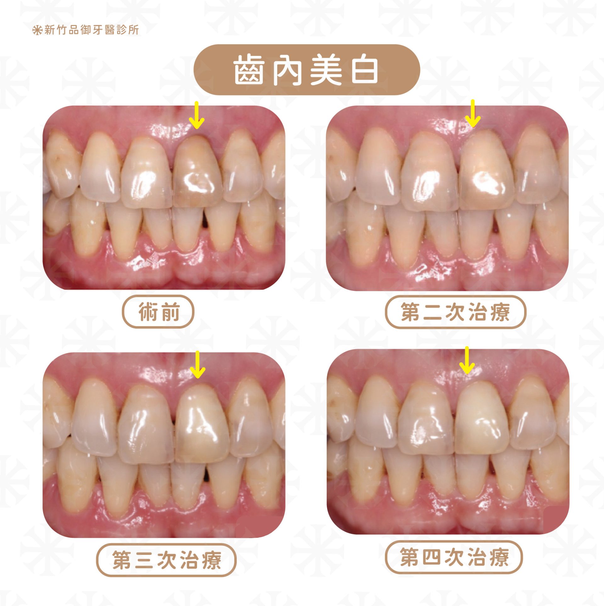 齒內美白,案例提供:方榮葳醫師 品御牙醫