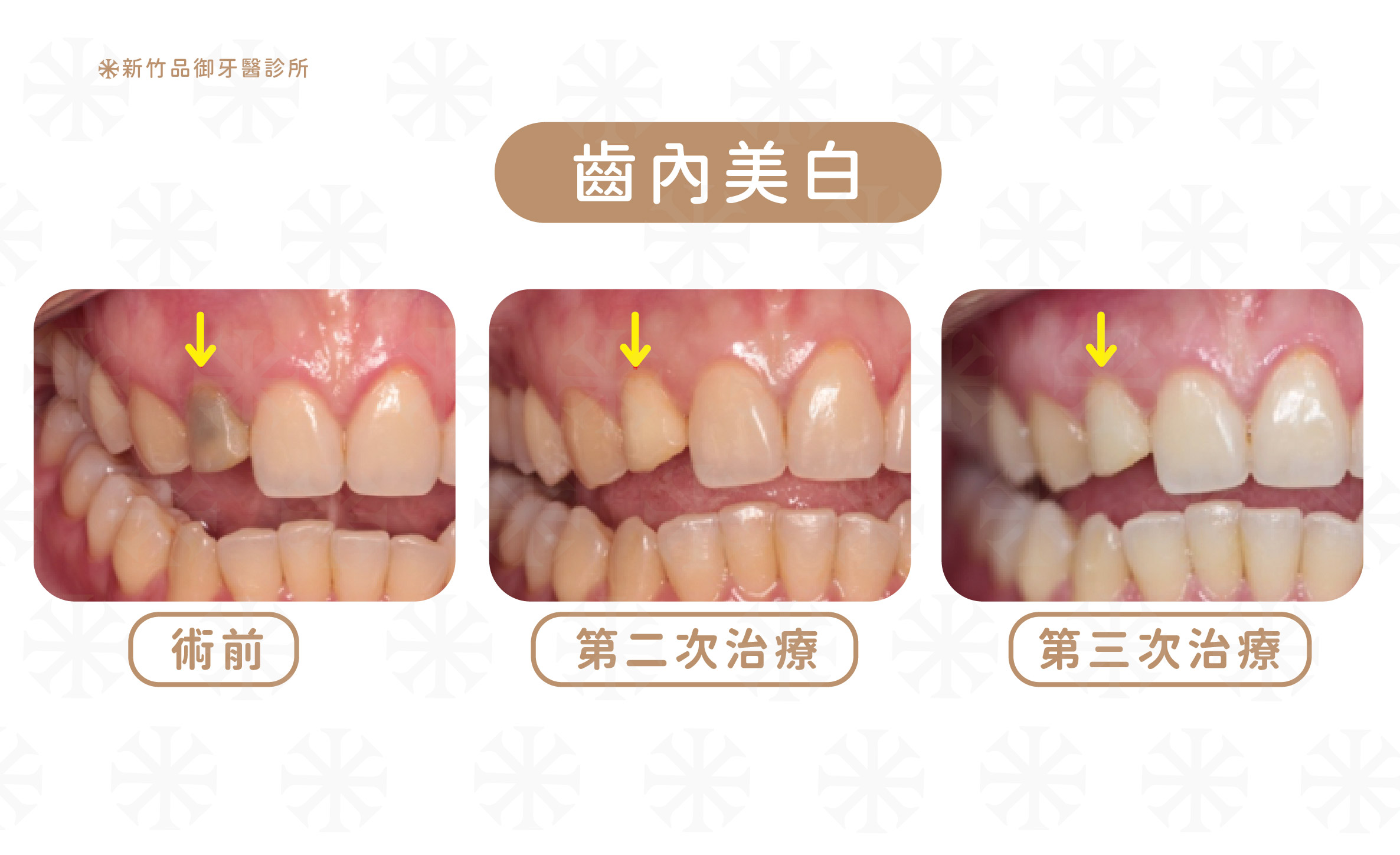 齒內美白,案例提供:方榮葳醫師 品御牙醫