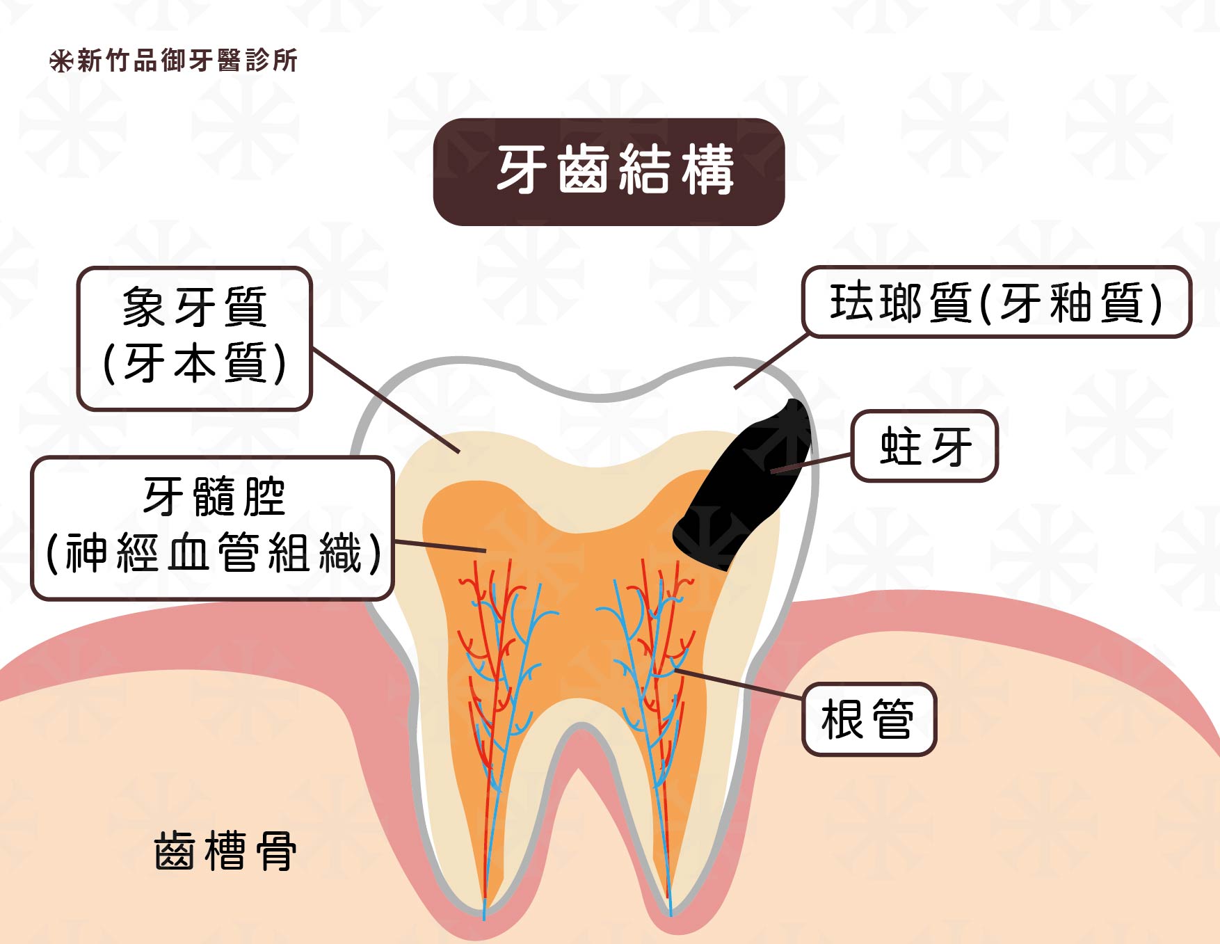 需要根管治療的主因:蛀牙範圍已經侵犯到牙髓腔