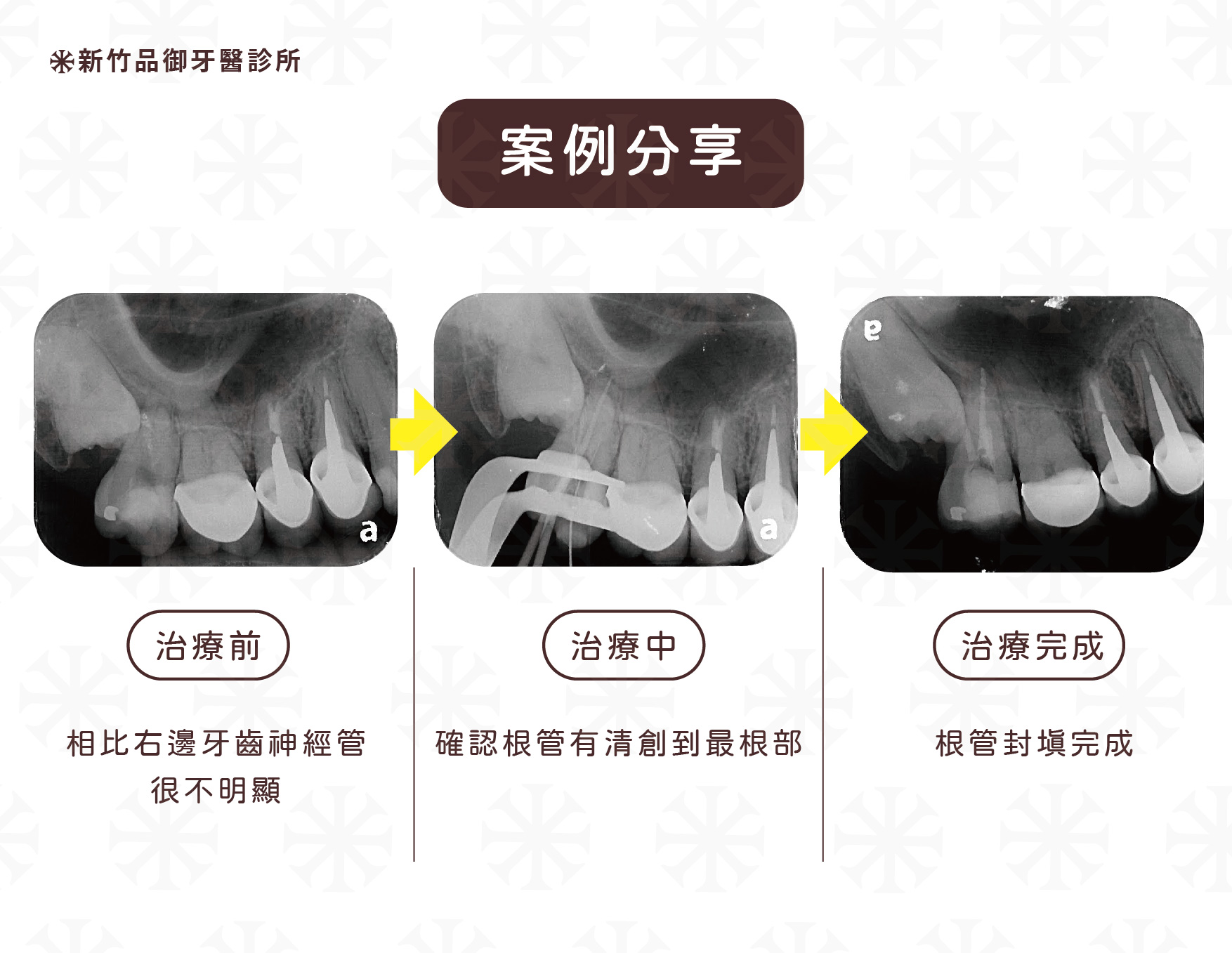 牙齒(左二)根管有鈣化的現象,相比其他牙齒神經管更不明顯且較難完整清創。
案例提供:侯達叡醫師 品御牙醫