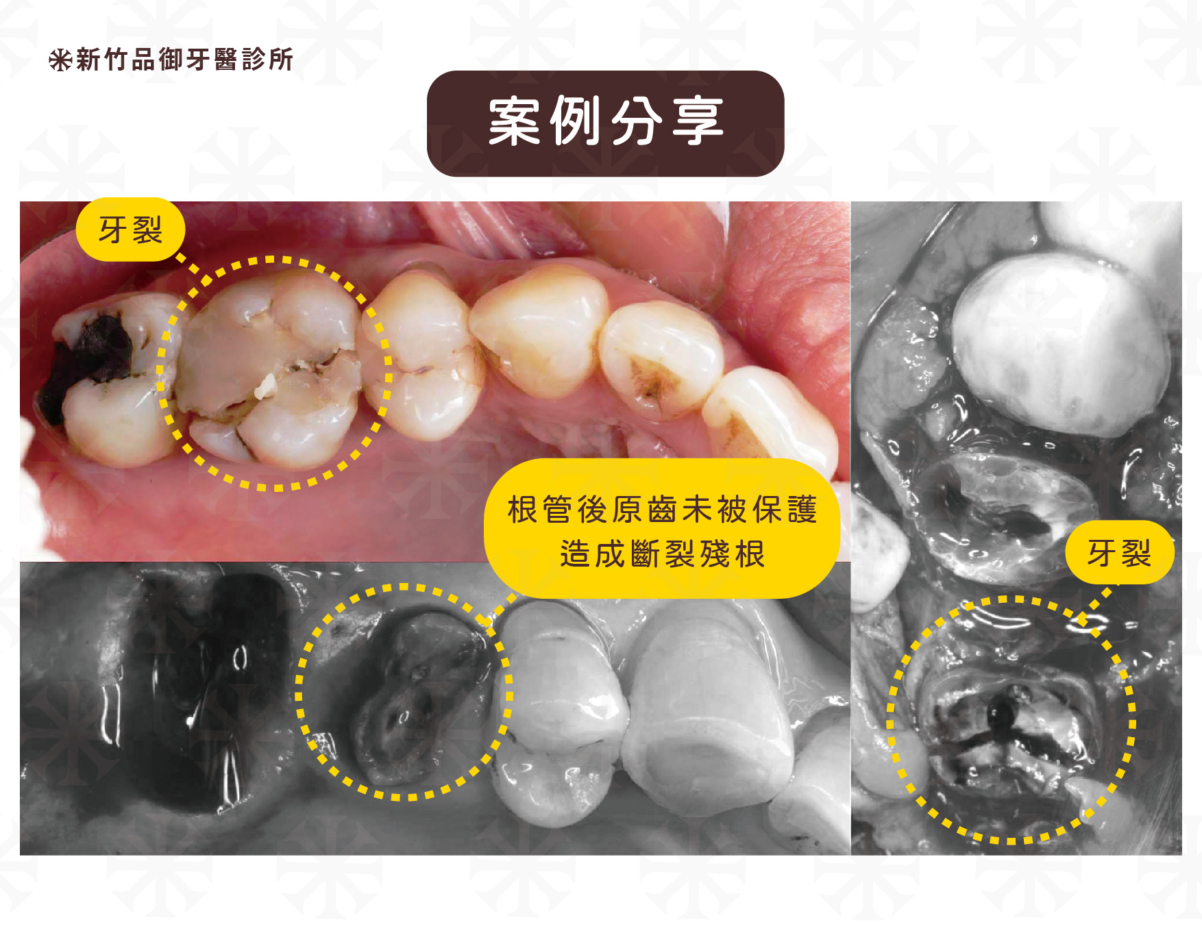 做完根管治療治療的牙齒如果沒有一個贗復體保護可能會產生斷裂,原因是做完根管治療的牙齒是很脆弱的。可以想像牙齒的神經就像我們人的血管負責輸送養分,當牙齒的神經被抽掉了之後就等於是一顆沒有養分的牙齒,會變得很脆弱。