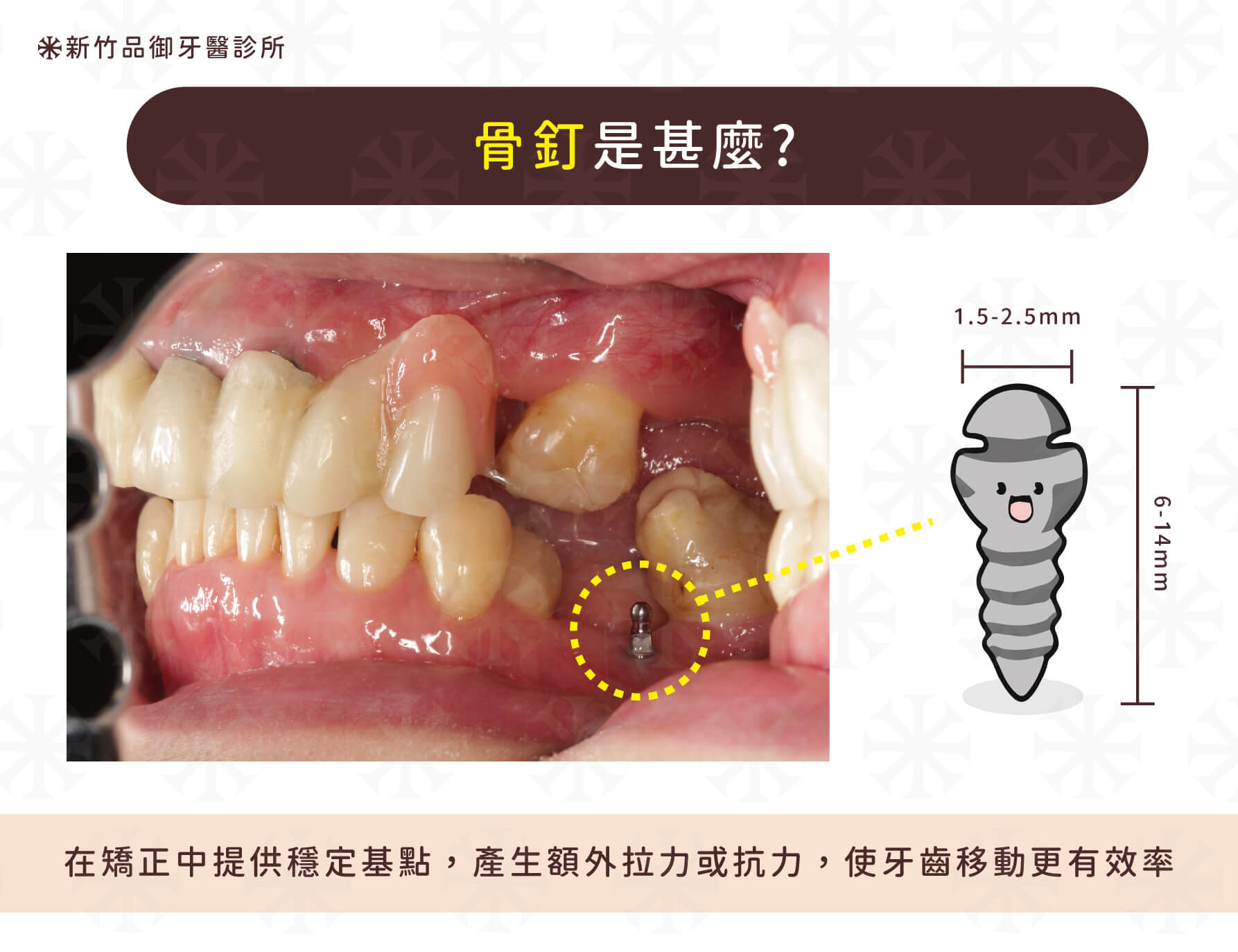 骨釘的正式名稱為暫時性錨定裝置 (Temporary Anchorage Device 簡稱TAD ),簡單來說,骨釘是「暫用定點裝置」,在矯正過程的作用提供穩定的定位基點,產生額外拉力或抗力,輔助矯正器施力,使拉動或收合牙齒能更有效率。