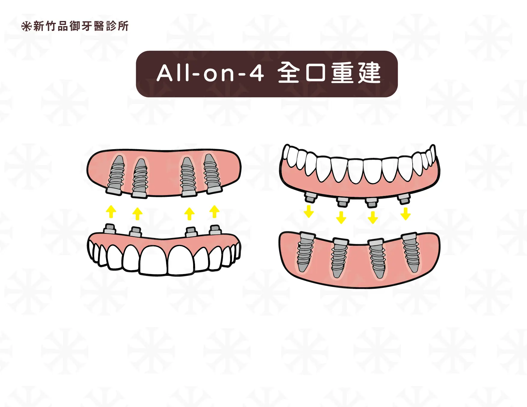 All-on-4 原理