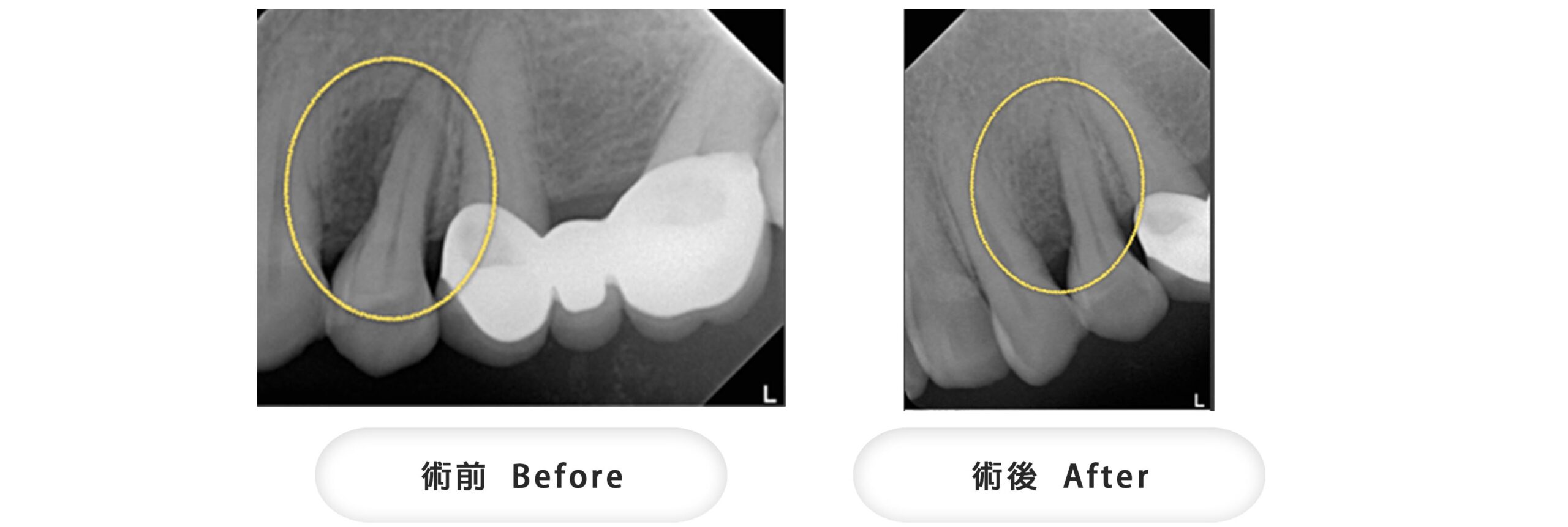 牙周再生手術,經過翻瓣清創後,填補骨粉及再生膜,可見到骨頭長回來。