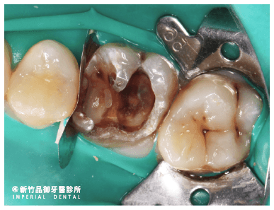 活髓治療前把蛀牙移除