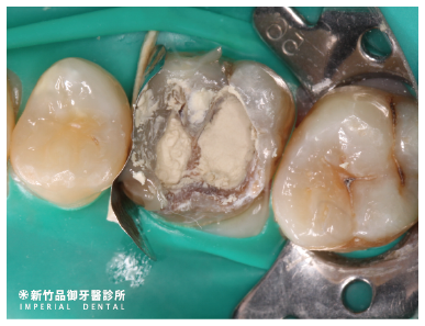活髓治療中填補