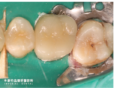 活髓治療後覆蓋填補物