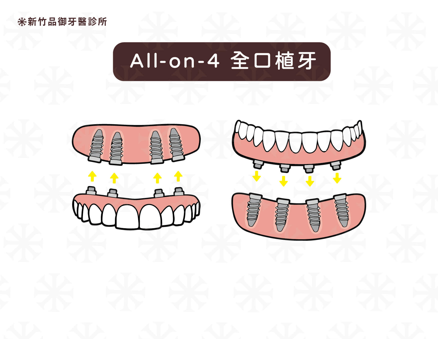 All-on-4 的基本原理:利用「斜張橋」的特殊力學設計,前面兩顆垂直植體,後面兩顆 30 度至 45 度植體,支撐單顎 12 顆牙,一日內獲得牙齒、恢復笑容。