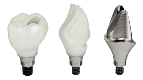implant crown