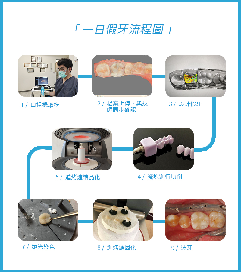 假牙推薦,假牙一日流程