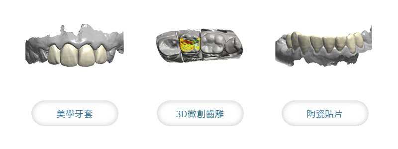 假牙推薦 數位掃描、設計假牙